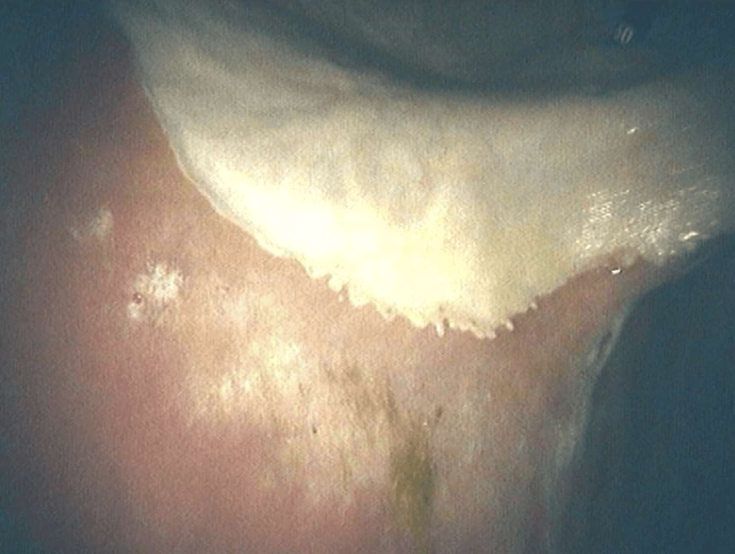 Normal-Lesser-Curvature-II