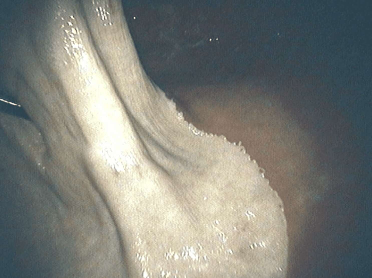 Normal-Lesser-Curvature